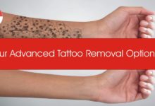 Four Advanced Tattoo Removal Options
