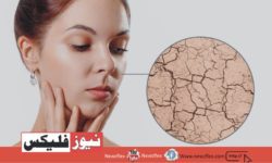 How to Get Rid of Dry Skin in Winters